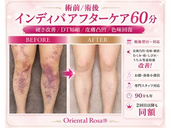 オリエンタルローザ 表参道(Oriental Rosa)の写真/脂肪術後・鼻術後・豊胸後に◎顔から体対応の術前術後インディバケア専門サロンダウンタイム軽減を専門技術