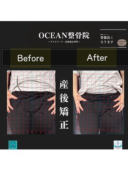 オーシャン整骨院(OCEAN整骨院)/産後矯正の骨盤ビフォーアフター