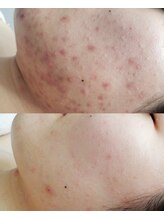 プシュケ(Psyche)/お客様の肌変化