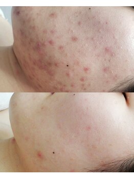 プシュケ(Psyche)/お客様の肌変化