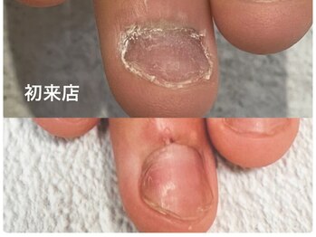 グレースレディ 大阪店/(深爪/長さだし/フィルイン/)