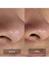 セレア(CELEA)/ハイドロ毛穴洗浄/黒ずみ/男性