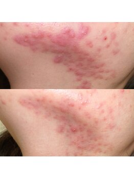 サロン ド ボーテ シャルル(Chaleureux)/突発的な肌荒れ編