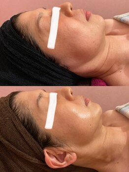 福岡美人工房 アロマムーン/ハーブピーリングで小顔効果も?