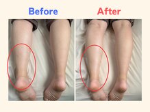 ピース/足のむくみにお悩みの30代女性