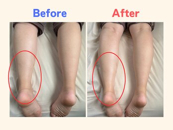 ピース/足のむくみにお悩みの30代女性