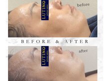 ルチノ(LUTINO)/目指せ☆小顔