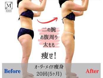マリス(MARISS)/オーダ-メイド痩身【痩身】