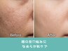 【毛穴カメラ診断付き毛穴洗浄】思わず触りたくなるうるつや卵肌に♪¥4,900