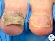 プラスワンフット 本厚木(+1 Foot)/変形・肥厚した爪を正常な爪へ