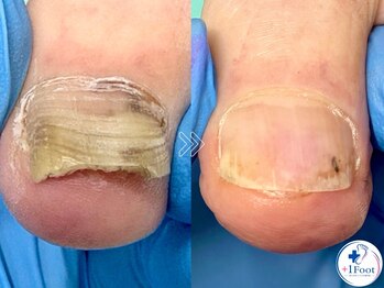 プラスワンフット 本厚木(+1 Foot)/変形・肥厚した爪を正常な爪へ