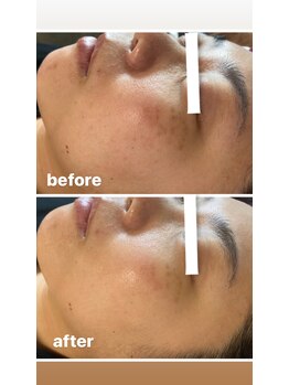 コティーバイホイヤ(Cotty by HOIYA)/◎ハーブトリートメント1回