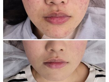 北原美顔/２０代女性/ニキビケア