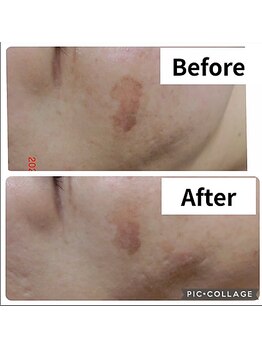 アンジェリーク/シミケア実績15年BA多数