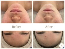 スキンセラピーサロン ル クレール(Le Clair)/Before→After