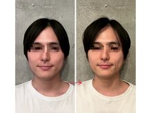 ビノワ(Binowa)/男性も小顔に（※男性は紹介制）