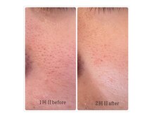 シュエット(Chouette)の雰囲気（渡韓しなくても受けられる！【韓国式ハーブピーリング】）