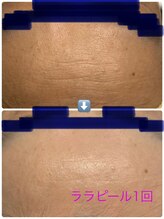 チェスタ/ララピール1回