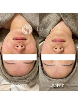 ルプレ(Lupure)/ハーブピーリング5回目