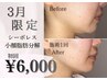 【3月限定★残り5枠】No.1☆集中小顔脂肪分解ケア☆9,000円 → 6,000円