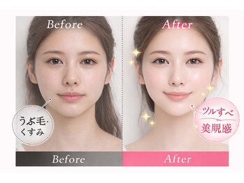 クリスタル(Crystal)/顔脱毛＋シミケア