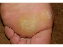 角質フットケアサロン リラックスパーク 大阪難波店(RelaxPark)/硬い足裏のたこ　ヒールタコ