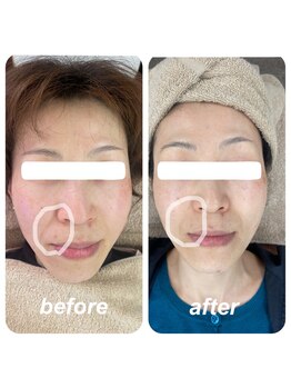 ヴィーナス(Venus)/ヒト幹細胞フェイシャルエステ