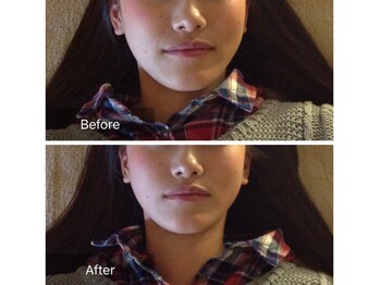 プレッシュ(Presh)/次世代小顔マシンエステ/肩こり