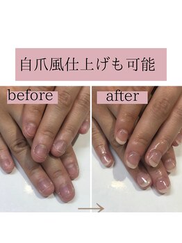 ティアラネイル(tiaranail)/再発させない深爪矯正