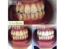 ルブラン 奈良店(Le Blanc)/回数が大事！！
