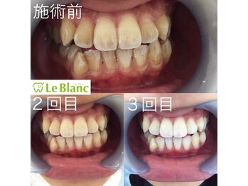 ルブラン 奈良店(Le Blanc)/回数が大事！！