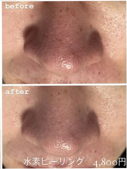 ユニセックスサロン アンシェル(UNISEXSALON UNCHEL)/【水素ピーリング】新規4,800円