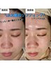 インフルエンサー御用達【水光艶肌リフティング】満足たるみ・小顔・肌ケア