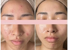 エイプリルフールズ(April fools)/【20代】大きいニキビも改善！