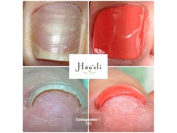 ハウオリ(Hau'oli)の写真/気になる爪の食い込みに…ジェルで行う巻き爪ケア☆１回目でも巻き爪が広がり楽になったと大満足の声多数◎