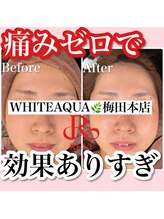 アルムダアクア 天王寺店(Aleumda AQUA)/ハーブピーリング/大阪/天王寺