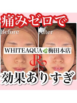 アルムダアクア 天王寺店(Aleumda AQUA)/ハーブピーリング/大阪/天王寺