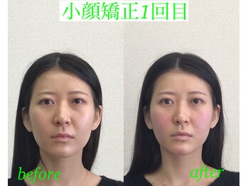 オズ六本木/小顔矯正モニター様1回目施術