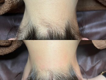 ゴールデンエイジ 吉祥寺(GOLDEN AGE)/ワックス脱毛:施術