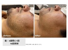 ロカビリー(Rockabilly)/メンズ　ヒゲ脱毛