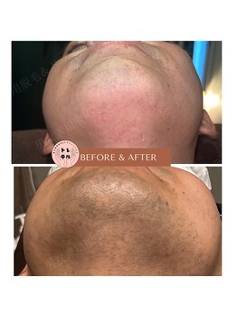 トレテル/メンズヒゲ脱毛