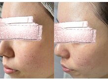 モガナ(mogana)/赤ちゃん肌ピーリング