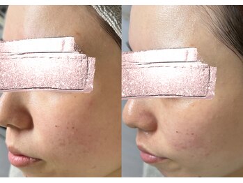 モガナ(mogana)/赤ちゃん肌ピーリング