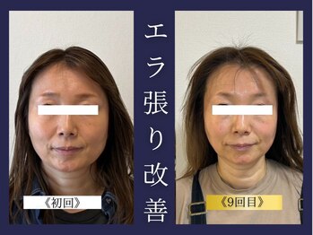 エレミュー 烏丸(Elemue.)/40代　《エラ改善》