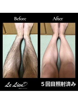 ルリアン(Le Lien)/【メンズ】足症例