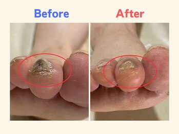 ピース/厚い爪に悩んでいた60代女性