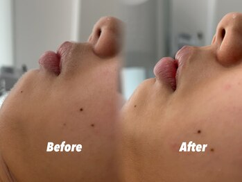 クイーン 渋谷店(QUEEN)/産毛が取れてトーンアップ