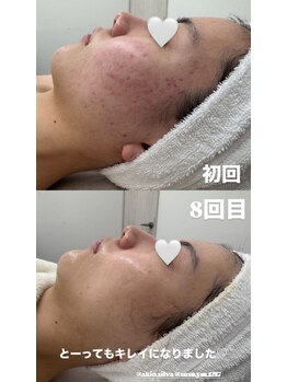 サロン ド アン(salon de An)/ハーブピーリング