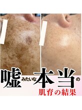 エステティックサロン ラ アクア(ra aqua)/全国１位に輝いたシミケア結果！