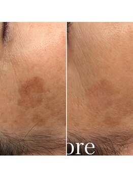 イディール(IDYLLE)/シミケア